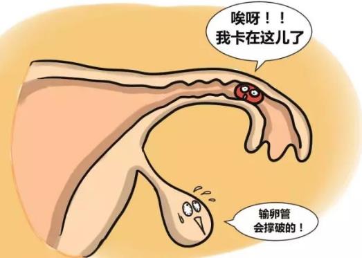 輸卵管妊娠的自我檢查、癥狀及治療方法