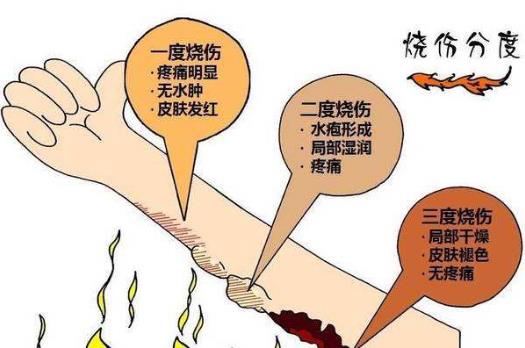 阻止繼續(xù)燒傷只要18秒