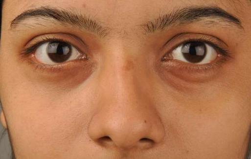 黑眼圈不僅是因?yàn)槟I虛 黑眼圈透露你身體的健康問題