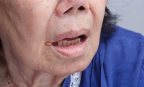 精神壓力大易導(dǎo)致口腔潰瘍 中醫(yī)偏方可治療口腔潰瘍