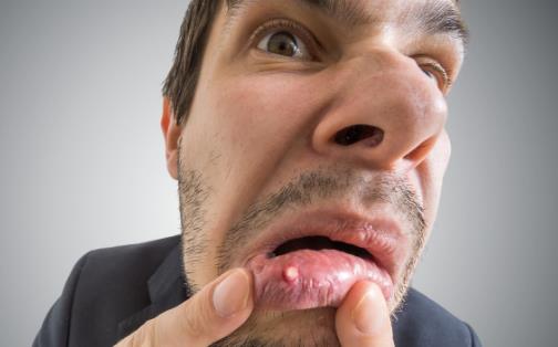 精神壓力大易導(dǎo)致口腔潰瘍 中醫(yī)偏方可治療口腔潰瘍