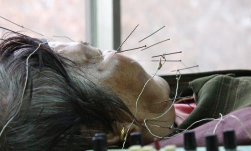 警惕！氣溫驟變，多人中招口眼歪斜、面部麻木……此季高