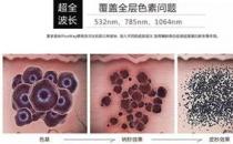 寧波薇琳整形醫(yī)院祛斑怎么樣？還您一張漂亮的容顏