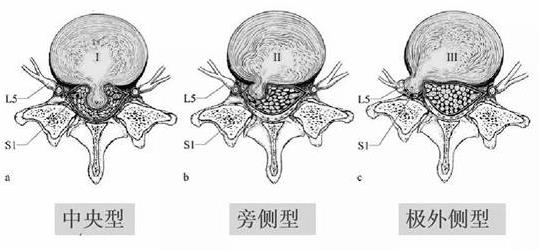 患上腰椎病，一定不能拖！內(nèi)鏡微創(chuàng)手術(shù)，一步治好它！