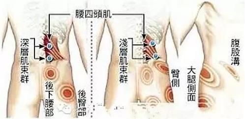 湛江崇愛康復醫(yī)院科普如何防治肌筋膜炎 以真誠來服務患者