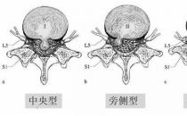 患上腰椎病，一定不能拖！內(nèi)鏡微創(chuàng)手術(shù)，一步治好它！