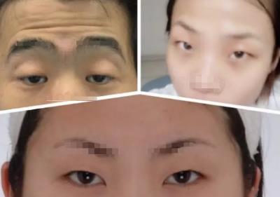 內(nèi)眥贅皮怎么做效果好——北京彤美整形醫(yī)院劉風卓
