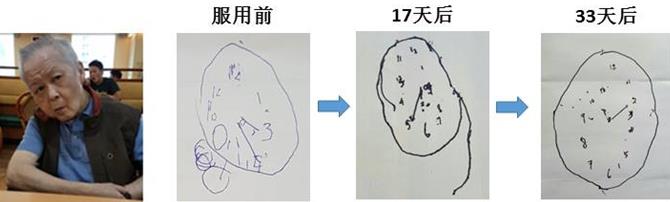 新加坡『腦復(fù)生』：改善老年癡呆的新希望
