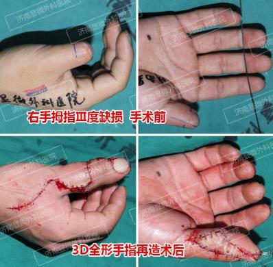 濟南顯微外科醫(yī)院 黃威手指再造怎么樣 有真實的手術案例嗎