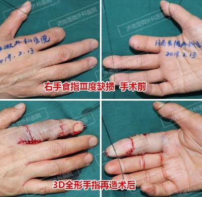 濟南顯微外科醫(yī)院 黃威手指再造怎么樣 有真實的手術案例嗎