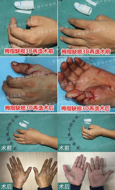濟南顯微外科醫(yī)院 黃威手指再造怎么樣 有真實的手術案例嗎