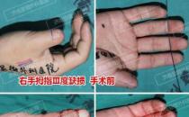 濟南顯微外科醫(yī)院 黃威手指再造怎么樣 有真實的手術(shù)案例嗎
