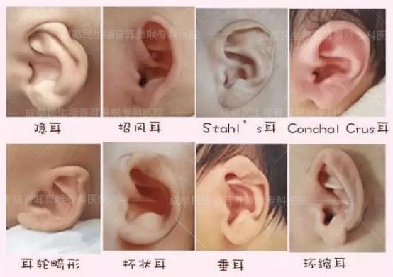 新生兒耳廓畸形能矯正嗎？看成都民生耳鼻喉醫(yī)院如何支招