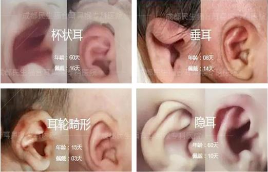 新生兒耳廓畸形能矯正嗎？看成都民生耳鼻喉醫(yī)院如何支招