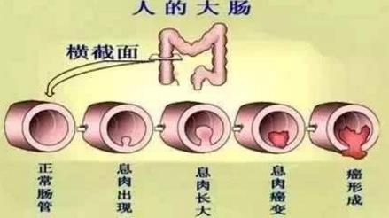 武漢漢西博仕肛腸醫(yī)院強調(diào)：痔瘡原本很好治 久拖治療難度加大
