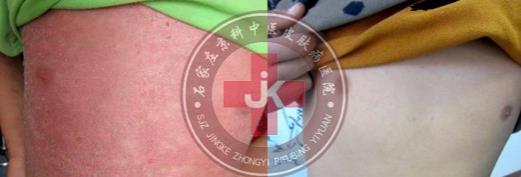 許光生：多年兒童牛皮癬終于治好，兒童牛皮癬怎么治