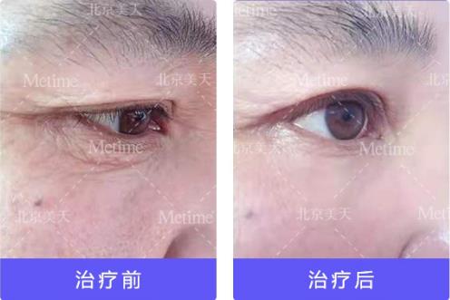 熱瑪吉抗衰(Thermage)官方認(rèn)證中國(guó)指定操作醫(yī)生—北京美天張潘院長(zhǎng)