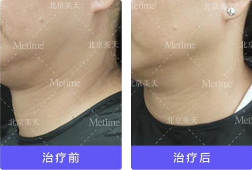 熱瑪吉抗衰(Thermage)官方認(rèn)證中國(guó)指定操作醫(yī)生—北京美天張潘院長(zhǎng)
