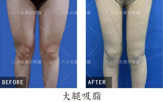八大處整形郭鑫教授解答：大腿吸脂手術瘦腿明顯嗎