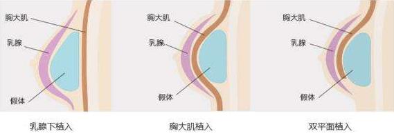 原來假體隆胸還可以這樣解釋！