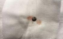 普瑞眼科取出患者眼內(nèi)5毫米金屬，保住眼球
