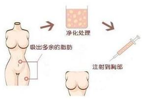 煤醫(yī)整形：自體脂肪豐胸的四大優(yōu)勢(shì)