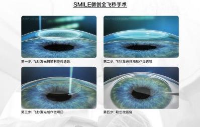 西安普瑞眼科醫(yī)院治療近視好？參軍入伍，近視手術(shù)提前半年做準備
