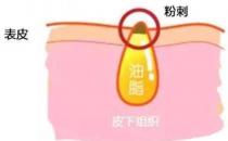甲硝唑凝膠去黑頭要看主流，別拿個體差異混淆視聽