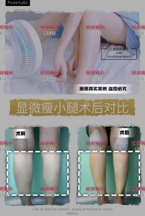 上海麗質(zhì)美學(xué)整形門(mén)診部做瘦小腿價(jià)格貴嗎？肌肉小腿太難減怎么辦
