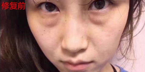 君雅筆記：眼袋過(guò)重，就會(huì)顯得比真實(shí)年齡大，要如何修復(fù)眼袋呢？