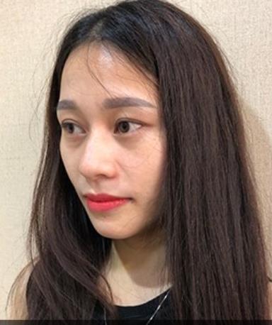 幻柔筆記：眼袋修復(fù)后氣質(zhì)立現(xiàn)，怎么看都是青春靚麗！
