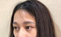 君雅筆記：眼袋過(guò)重，就會(huì)顯得比真實(shí)年齡大，要如何修復(fù)眼袋呢？