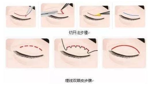 上海玫瑰整形醫(yī)院雙眼皮手術(shù)怎么樣？輕松擁有靚麗雙眼