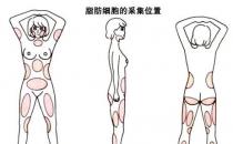 韋元強：產(chǎn)后能做自體脂肪豐胸嗎？