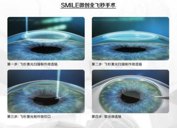西安普瑞眼科醫(yī)院好嗎？戴眼鏡VS近視手術(shù)，四個(gè)對(duì)比讓你不糾結(jié)
