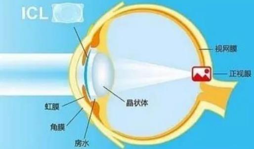 西安普瑞眼科醫(yī)院好嗎？戴眼鏡VS近視手術(shù)，四個(gè)對(duì)比讓你不糾結(jié)