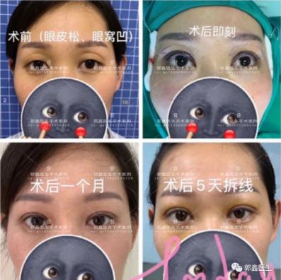 八大處整形郭鑫：上眼瞼凹陷脂肪填充圖片