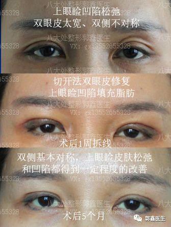 八大處整形郭鑫：上眼瞼凹陷脂肪填充圖片