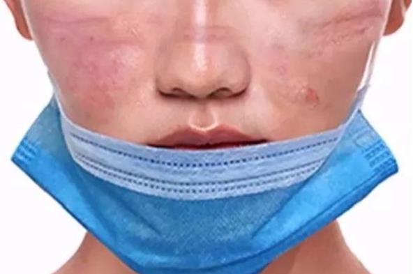 長(zhǎng)期戴口罩痘痘叢生？有甲硝唑凝膠祛痘不用慌