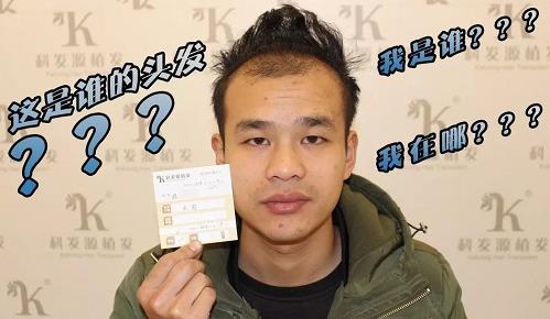 青島大麥微針植發(fā)2500毛囊單位，術(shù)后8個月恢復(fù)頭發(fā)濃密
